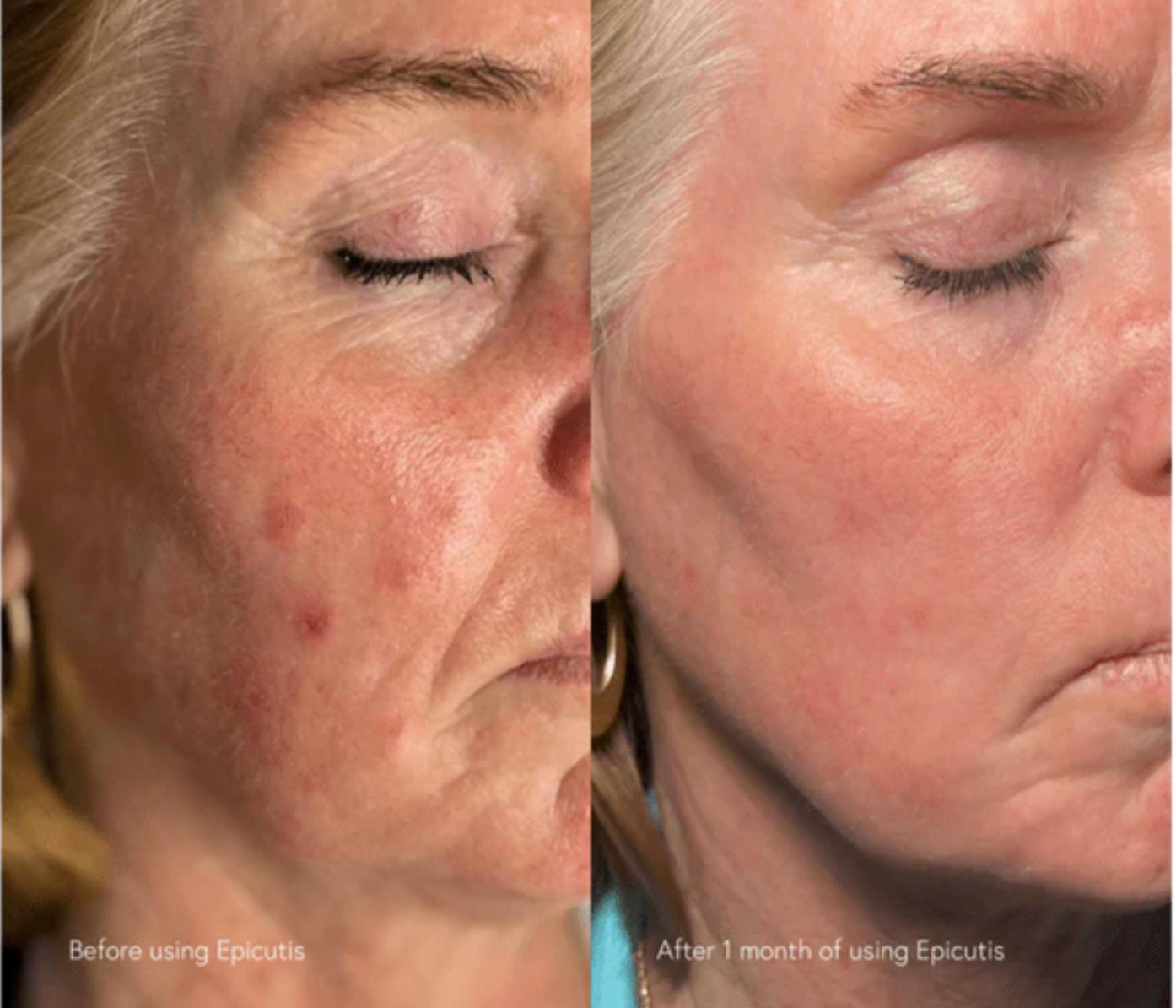 Epicutis Post-Procedure Set